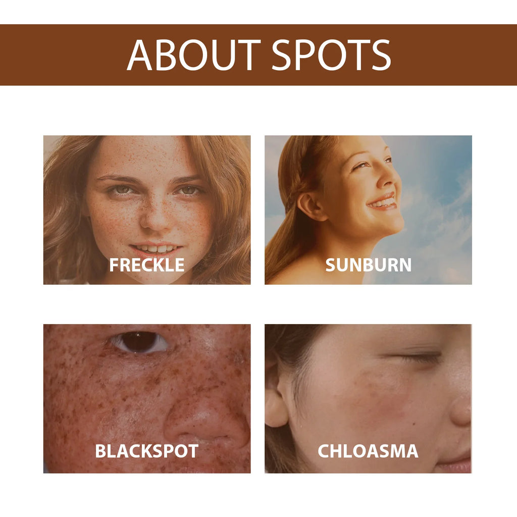 Whitening Freckle Serum Dark Spots Remover Lightening Melasma Melanin Fade Pigmentation Brighten Hydrating Nicotinamide Essence